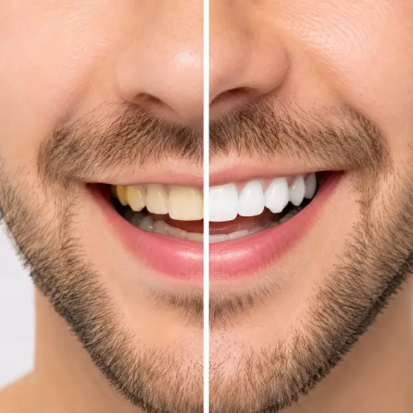Teeth Whitening