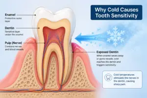 Tooth cross section showing exposed dentin and sensitivity to cold